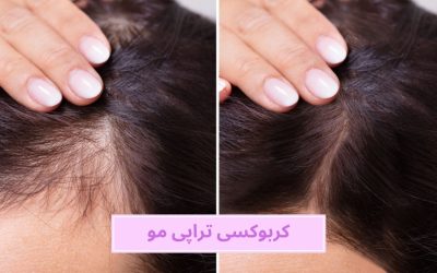 کربوکسی تراپی مو چیست؟ مزایا، کاربرد و عوارض آن