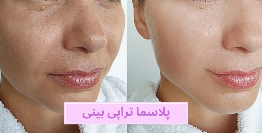 پلاسما تراپی بینی چیست؟ مزایا، نحوه انجام و مراقبت های قبل و بعد
