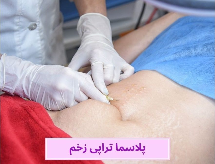 تأثیر پلاسما تراپی زخم در ترمیم و بهبود انواع زخم