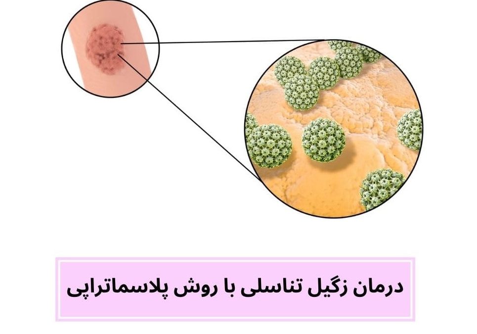 درمان زگیل تناسلی با روش پلاسماتراپی