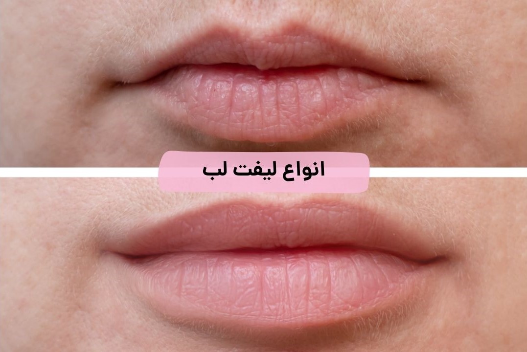 انواع روش های لیفت لب کدامند؟ - مرکز زیبایی لیا