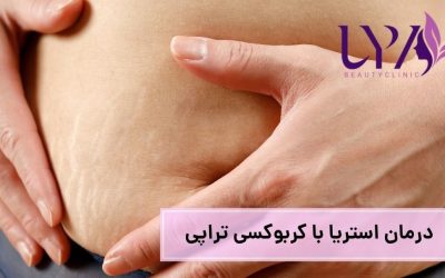 درمان ترک پوستی با کربوکسی تراپی چگونه است؟