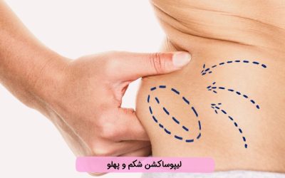 لیپوساکشن شکم و پهلو چیست؟