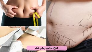 انواع جراحی زیبایی شکم