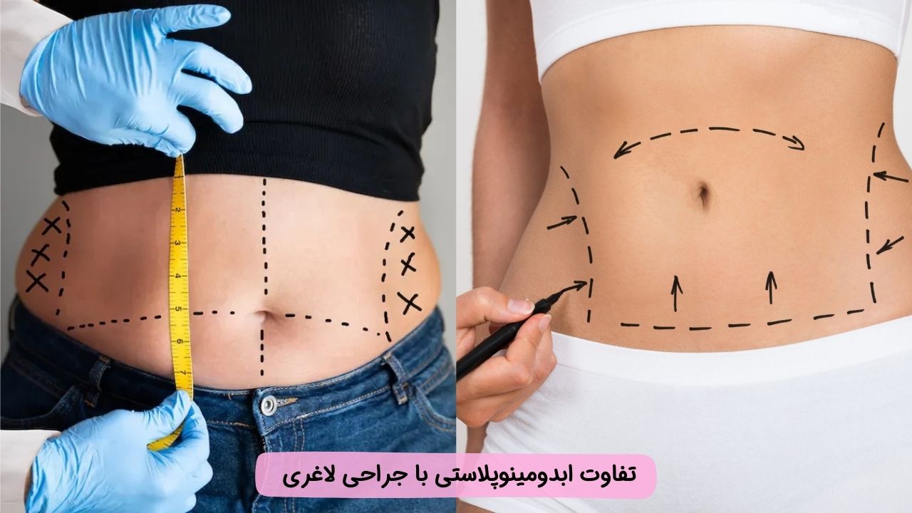 تفاوت ابدومینوپلاستی با جراحی لاغری
