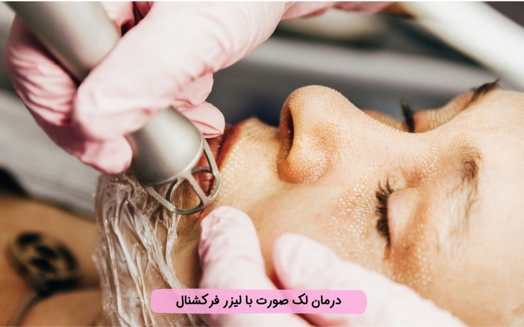 درمان لک صورت با لیزر فرکشنال