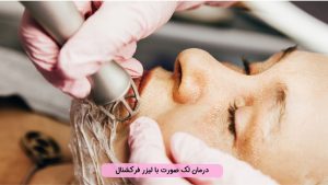 درمان لک صورت با لیزر فرکشنال