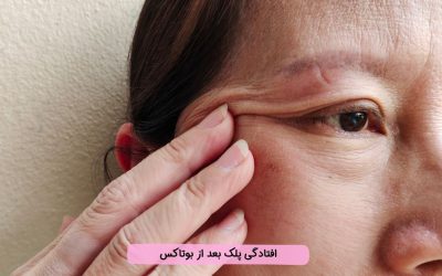 افتادگی پلک بعد از بوتاکس
