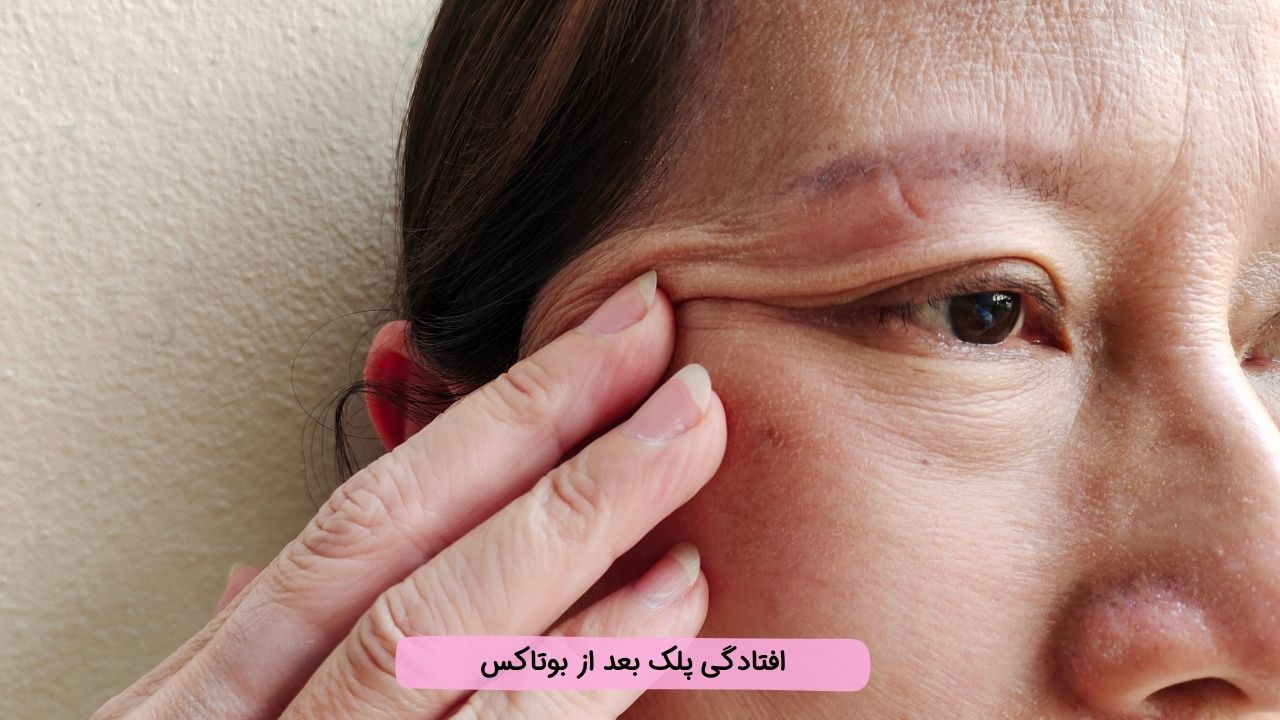 بلفاروپلاستی با لیزر بلفاروپلاستی با لیزر