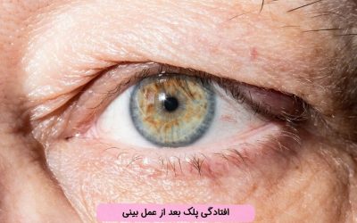 افتادگی پلک بعد از عمل بینی