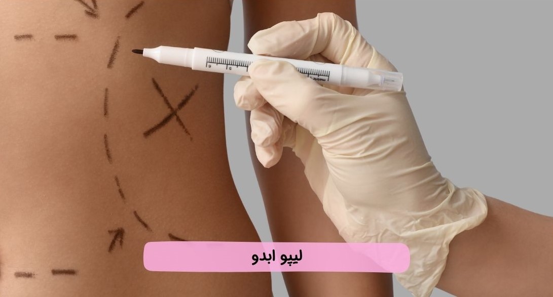 بلفاروپلاستی با لیزر بلفاروپلاستی با لیزر