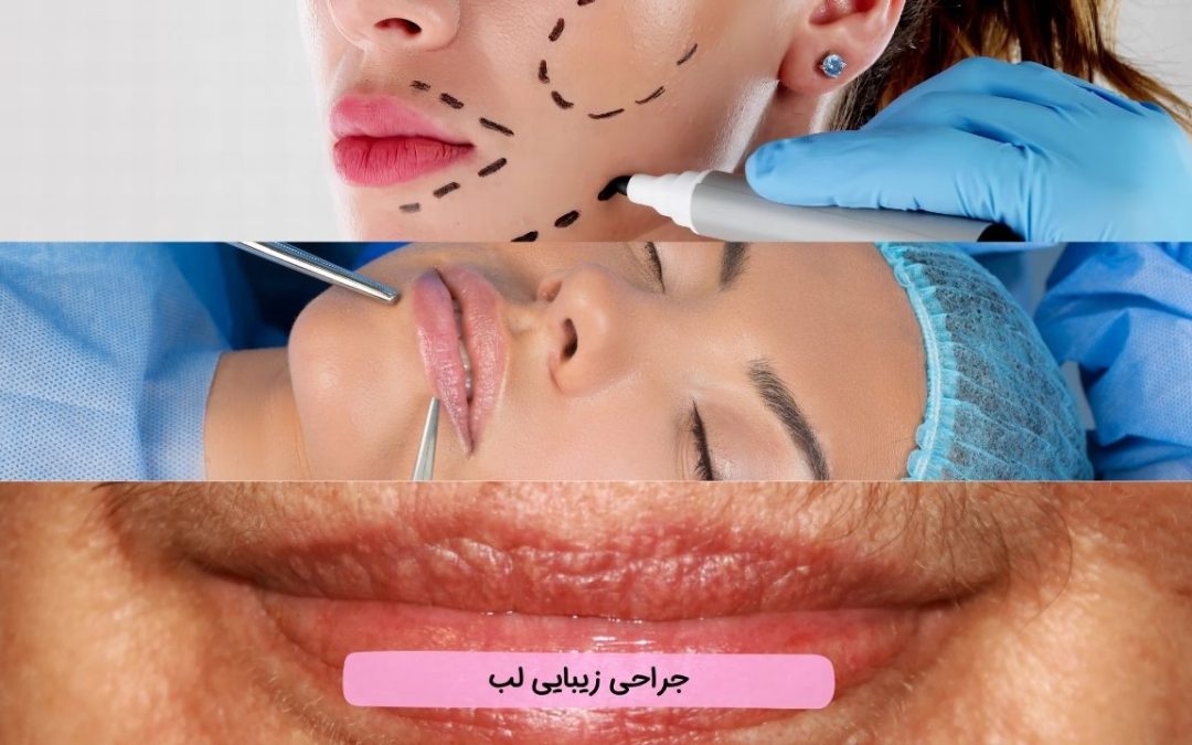 جراحی زیبایی لب: انواع، مزایا و معایب