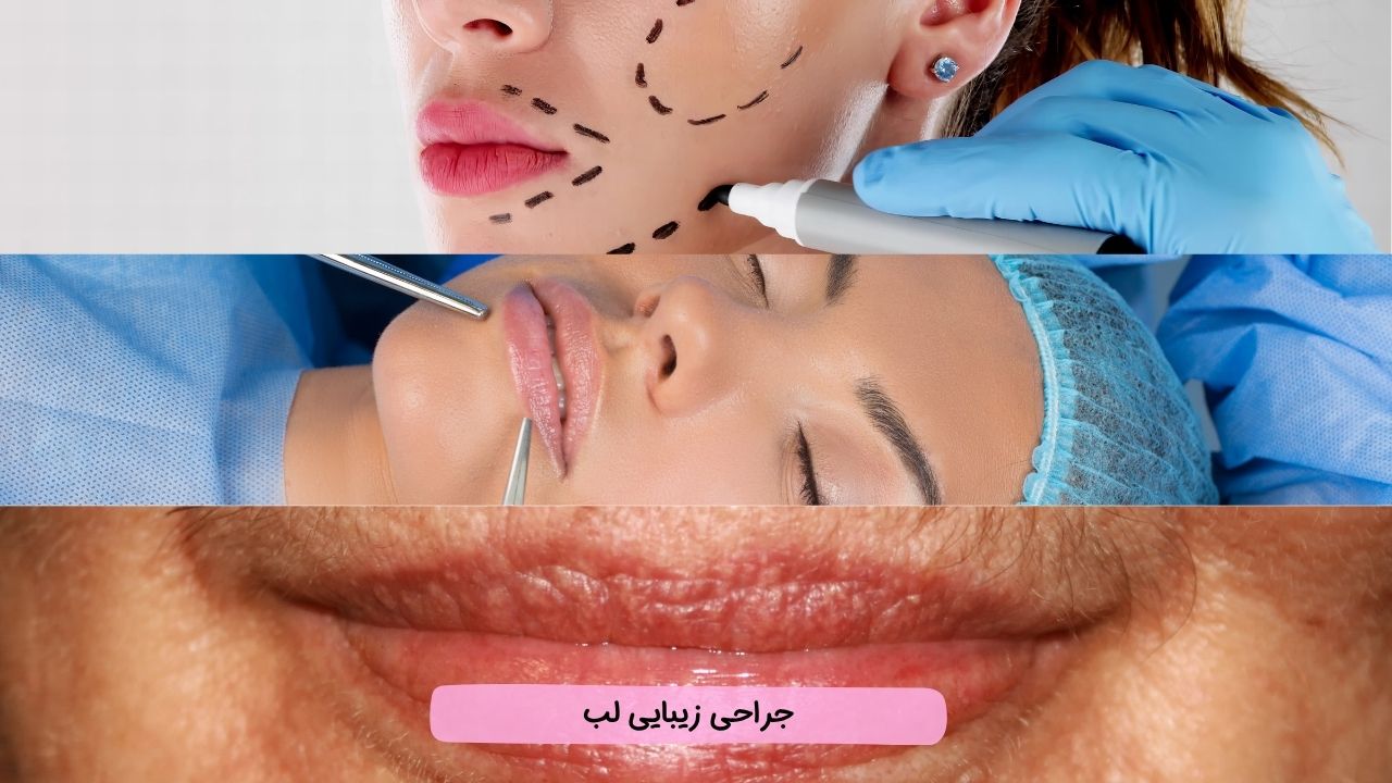 بلفاروپلاستی با لیزر بلفاروپلاستی با لیزر