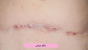درمان اسکار جراحی