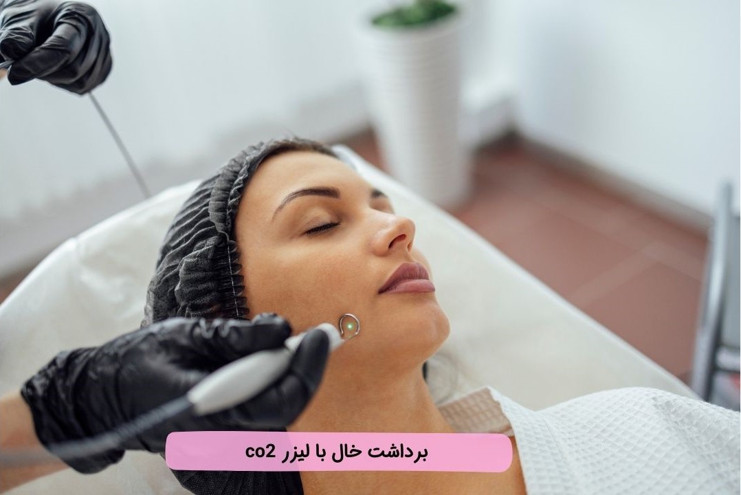 بلفاروپلاستی با لیزر بلفاروپلاستی با لیزر