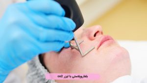 بلفاروپلاستی با لیزر CO2
