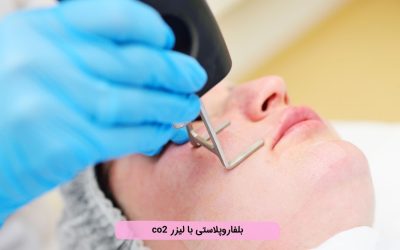 بلفاروپلاستی با لیزر CO2 چیست؟ مزایا و نتایج