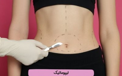 لیپوماتیک چیست؟ مزایا، عوارض، انواع و نکات مهم عمل