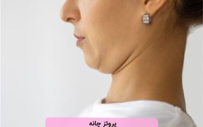 پروتز چانه چیست؟ | مزایا، نحوه جراحی، ماندگاری، عوارض