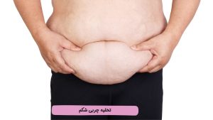 تخلیه چربی شکم