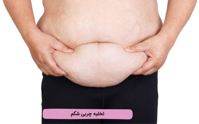 تخلیه چربی شکم: انواع روش جراحی و بدون جراحی