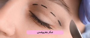 اسکار بلفاروپلاستی