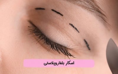 رفع اسکار بلفاروپلاستی بعد ازعمل