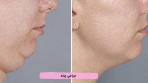 جراحی چانه