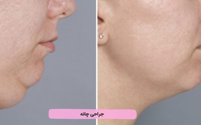 جراحی چانه چیست؟ انواع، کاربرد، نحوه انجام و دستورات قبل عمل