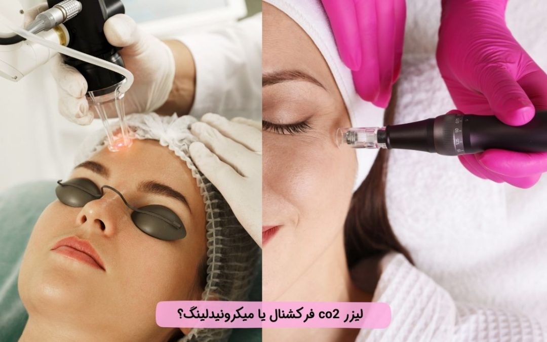 لیزر CO2 فرکشنال بهتر است یا میکرونیدلینگ؟