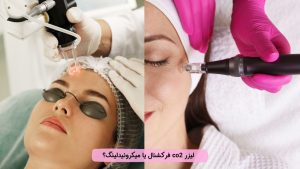 لیزر CO2 فرکشنال بهتر است یا میکرونیدلینگ