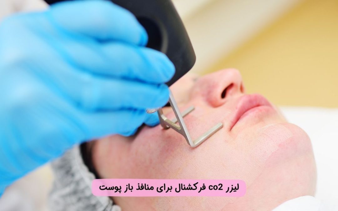 درمان منافذ باز پوست با لیزر co2 فرکشنال