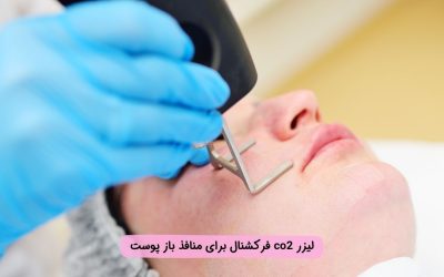درمان منافذ باز پوست با لیزر co2 فرکشنال