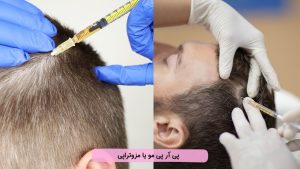 پی آر پی مو بهتر است یا مزوتراپی؟