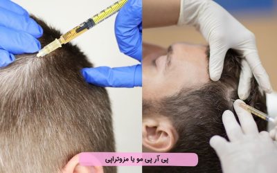 پی آر پی مو بهتر است یا مزوتراپی؟»