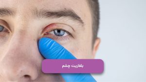 بلفاریت چشم