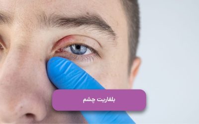 بلفاریت چشم: چیست، درمان، علت و علائم