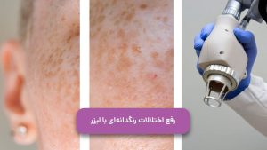 رفع اختلالات رنگدانه ای با لیزر