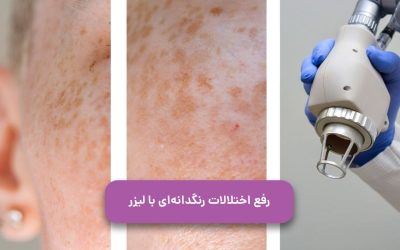 رفع اختلالات رنگدانه ای با لیزر | لیزر رنگدانه های پوستی