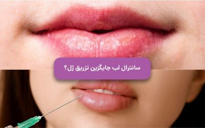 آیا سانترال لب جایگزین تزریق فیلر لب است؟
