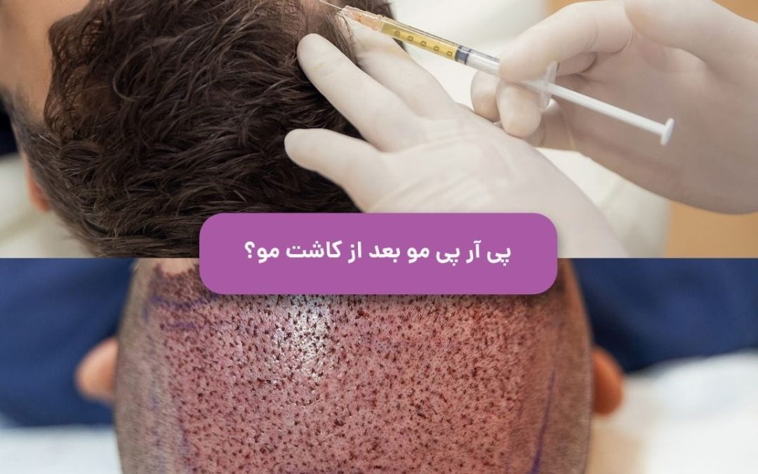 پی آر پی مو بعد از کاشت مو موثر است؟
