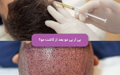 پی آر پی مو بعد از کاشت مو موثر است؟