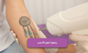 پاک کردن تاتوی قدیمی با لیزر