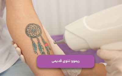 پاک کردن تاتوی قدیمی با لیزر